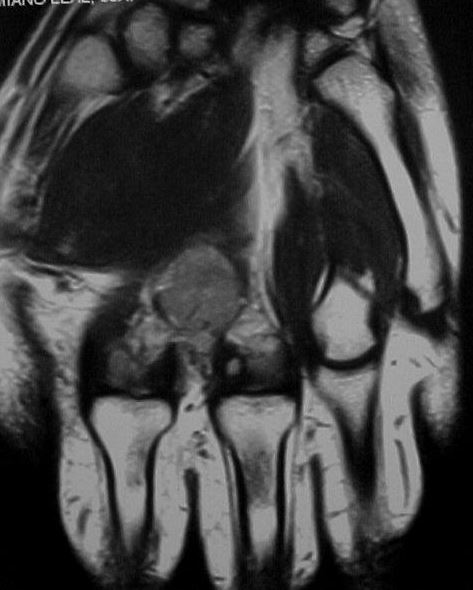 Figure 5 for case Glomus tumors
